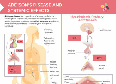Addison's disease