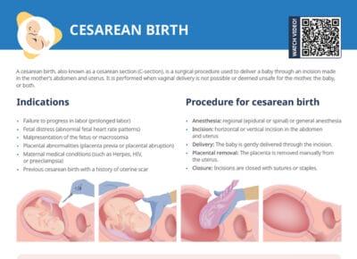 Nursing cs cesarean birth