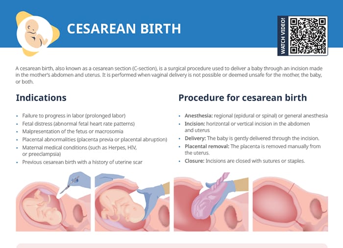 Nursing cs cesarean birth