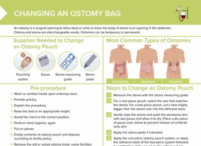 Changing an ostomy bag