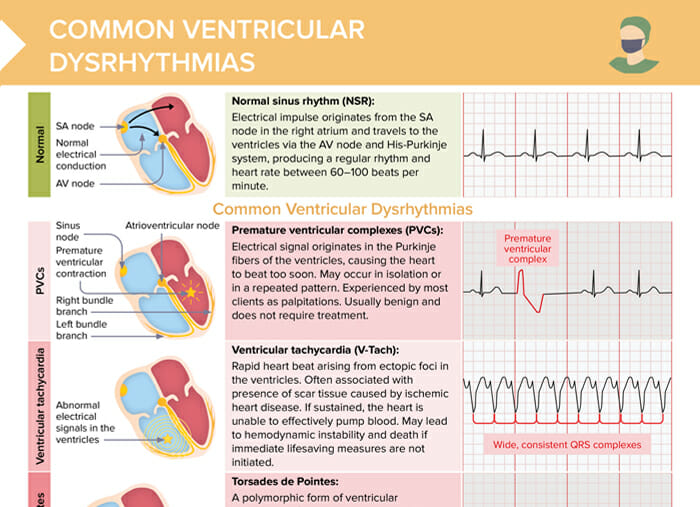 Overview of common ventricular dysrhythmias, cardiac conduction patterns, and associated ekg changes
