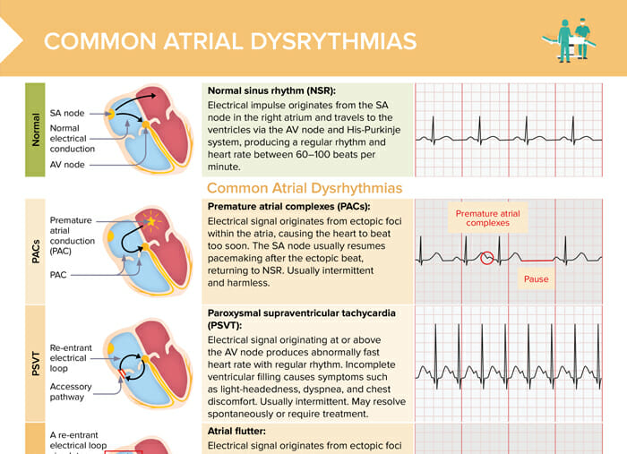 Overview of common atrial dysrhythmias, cardiac conduction patterns and associated ekg findings