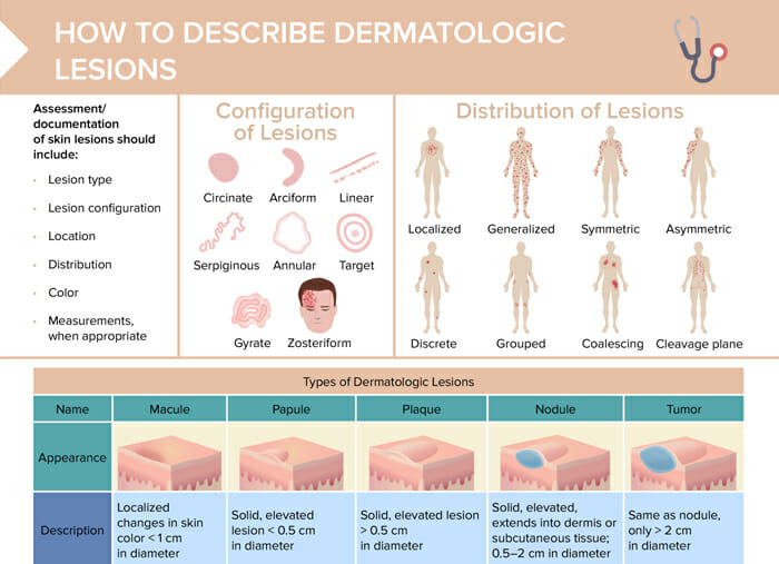 An overview of how to describe skin lesions