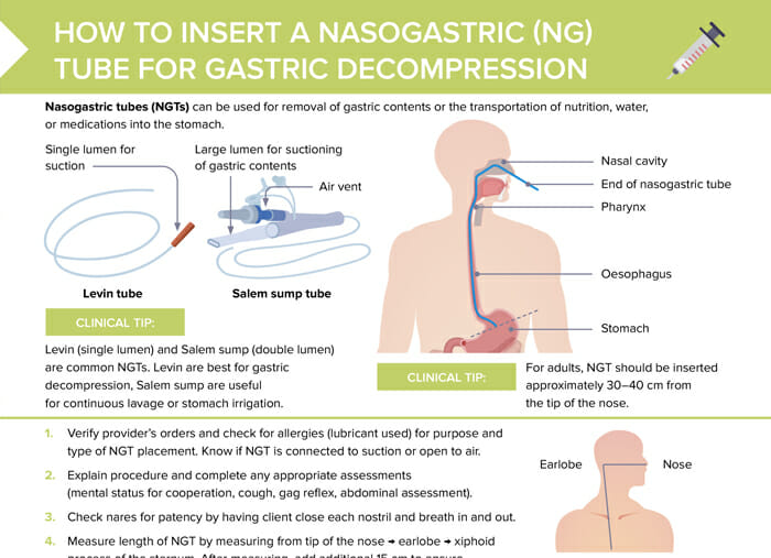 Nursing cs how to insert a nasogastricng tube for gastric decompression