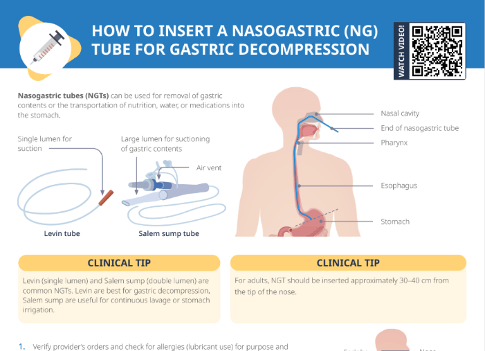 Thumbnail for Lecturio's How to Insert a Nasogastric Tube of Gastic Decompression Cheat Sheet