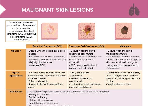 An overview of the most common types of skin cancers