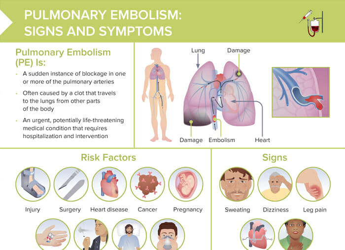 Nursing cs pulmonary embolism signs and symptoms
