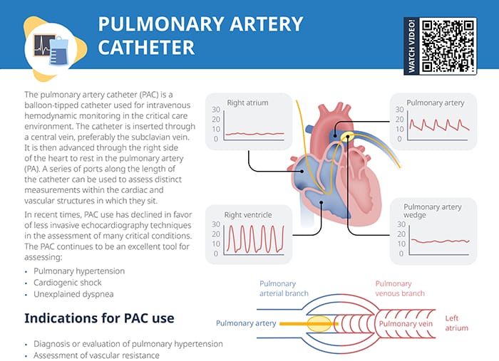 Pulmonary artery catheter guide