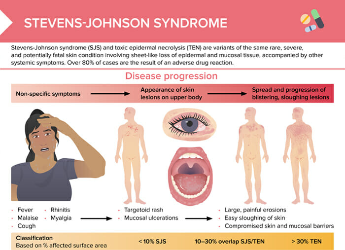 Stevens-johnson syndrome at a glance