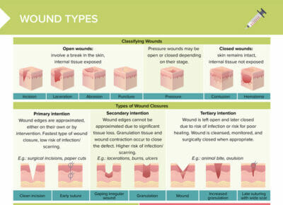 Types of Wounds [+ Free Cheat Sheet] | Lecturio