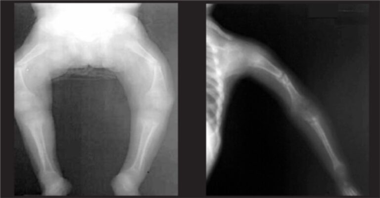 Osteomalacia And Rickets | Concise Medical Knowledge