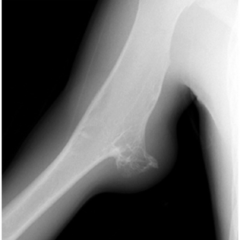 Oblique radiograph of the right arm shows soft tissue swelling overlying a broad-based osteochondroma
