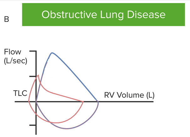 Obstructive lung disease graph