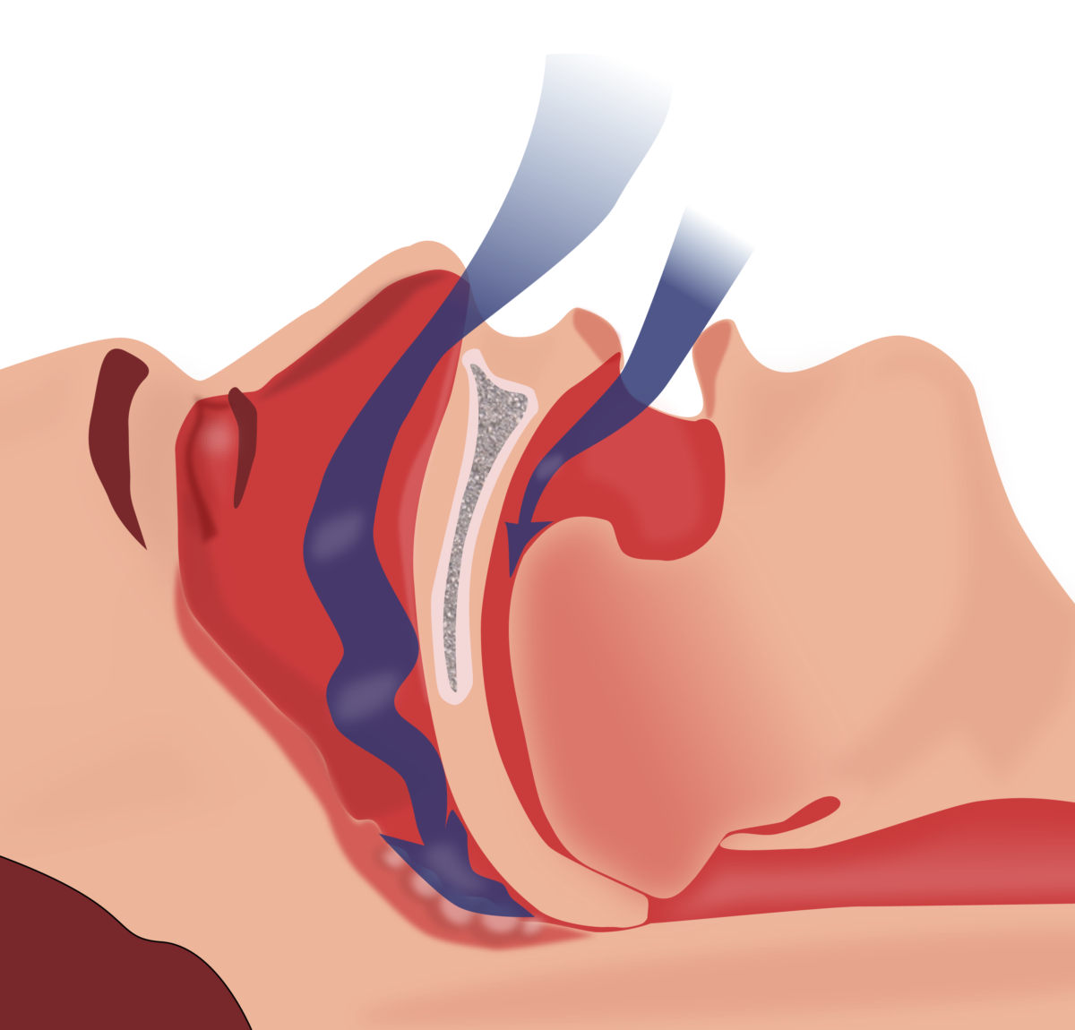 Obstructive Sleep Apnea Concise Medical Knowledge 5289