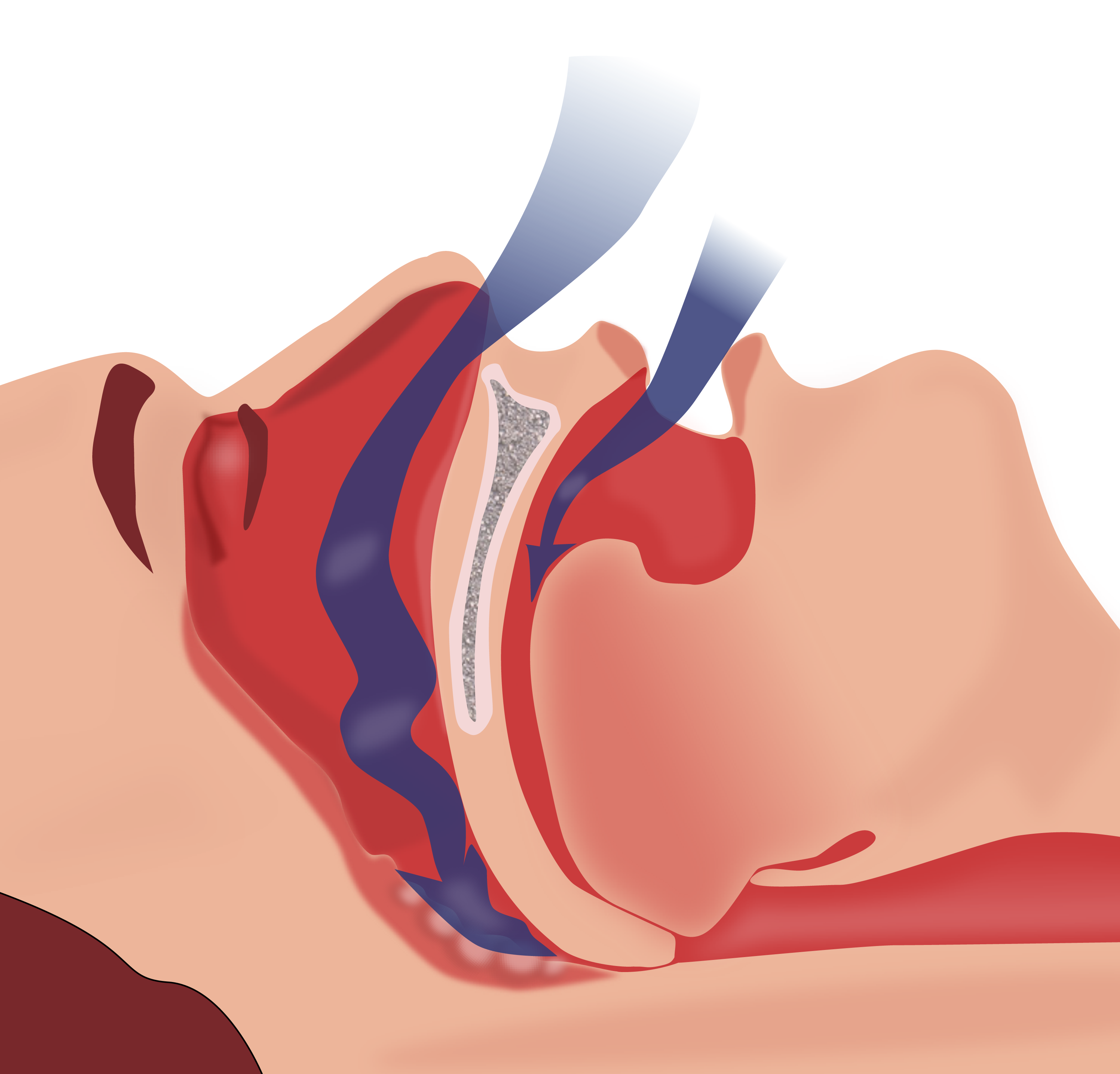 Obstructive sleep apnea 1