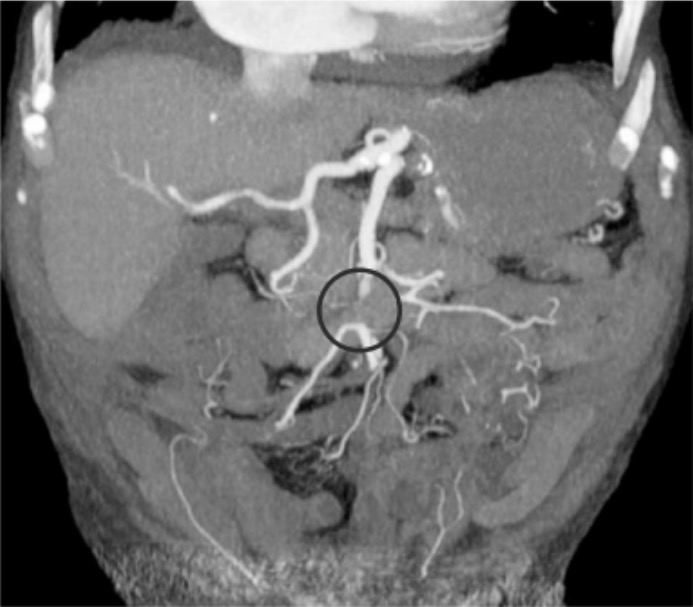 Occlusive acute embolism of the mid portion of sma stem