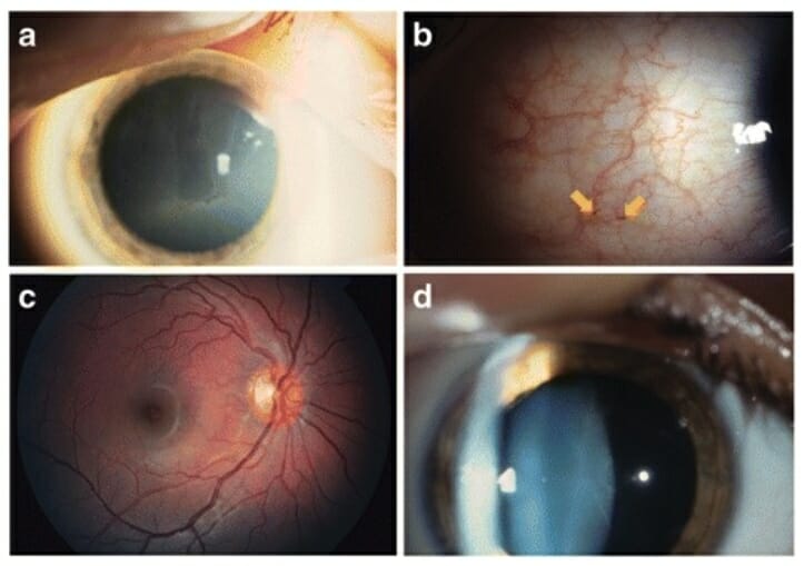 Ocular changes in fabry disease