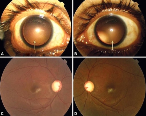Ocular presentation of marfan syndrome