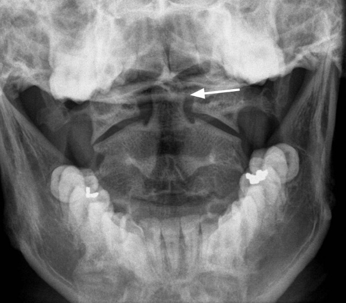 Odontoid x-ray