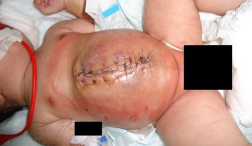 Omphalocele with mesh