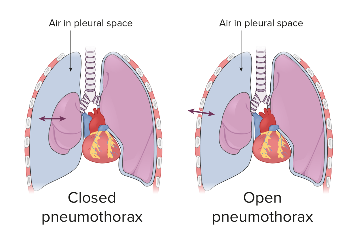 Pneumotórax aberto e fechado