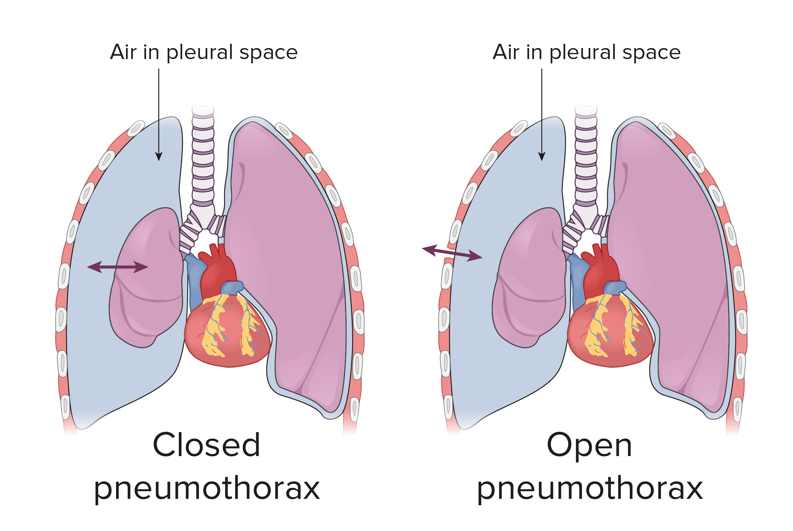 tension pneumothorax