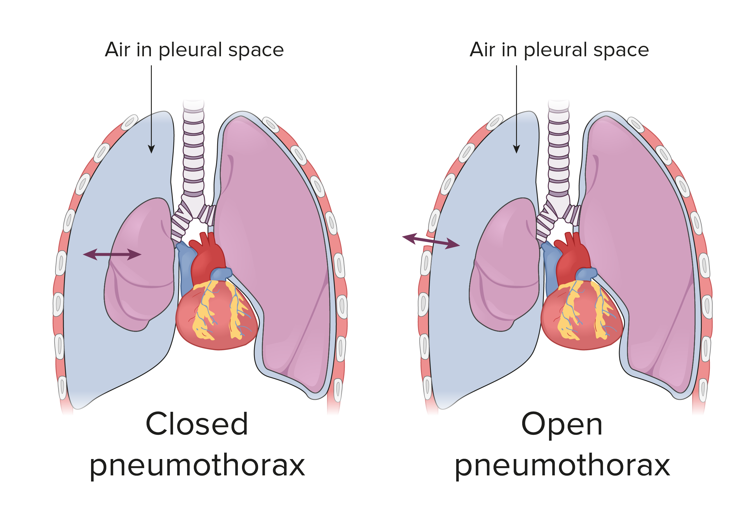 Pneumothorax: Definition, Types And Classification Preview, 43% OFF