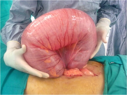 Achados cirúrgicos mostrando grande volvo de sigmóide