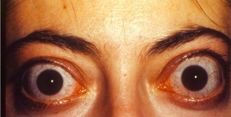 Ophthalmopathy due to graves disease