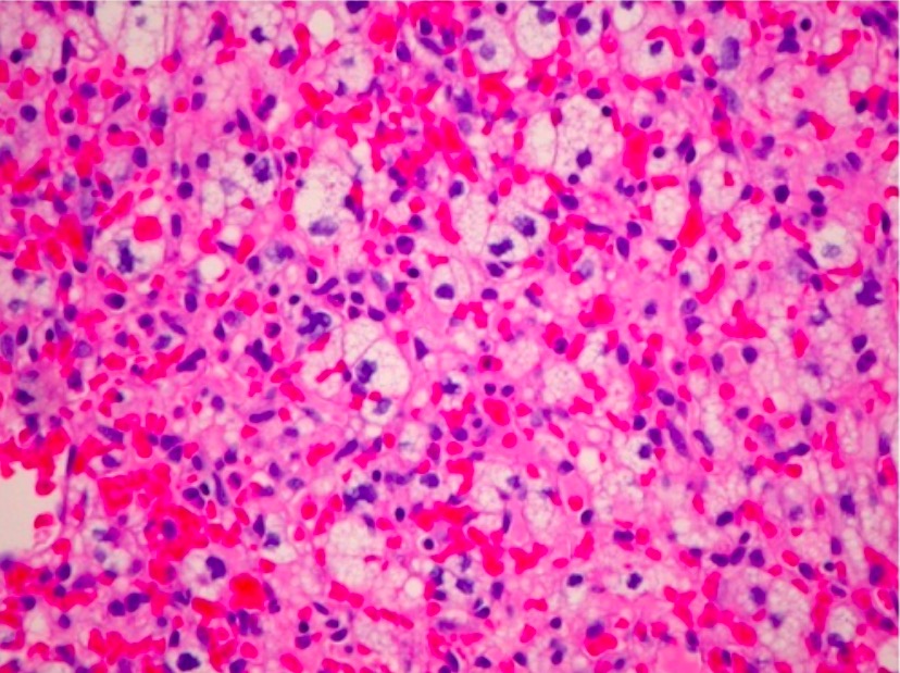 Hemangioblastoma del nervio óptico