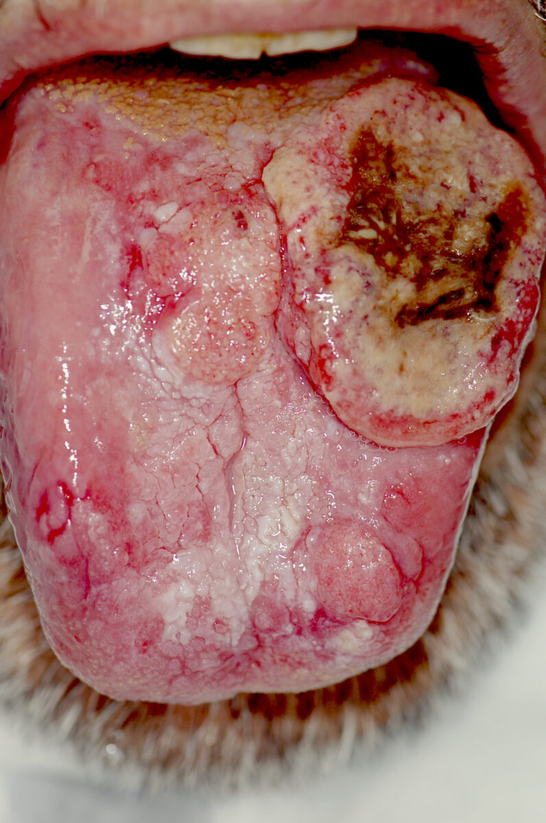 Oral carcinoma with exophytic tongue masses