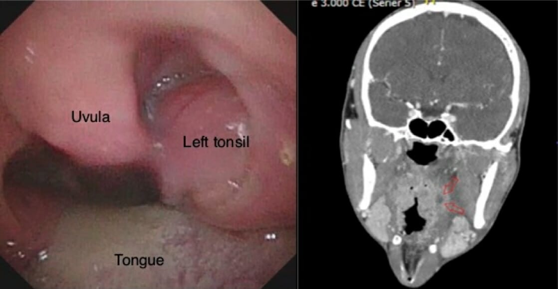 Oral exam with left-side peritonsillar swelling and ct with abscess