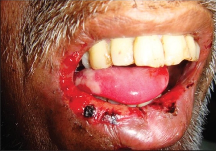 Mucositis oral