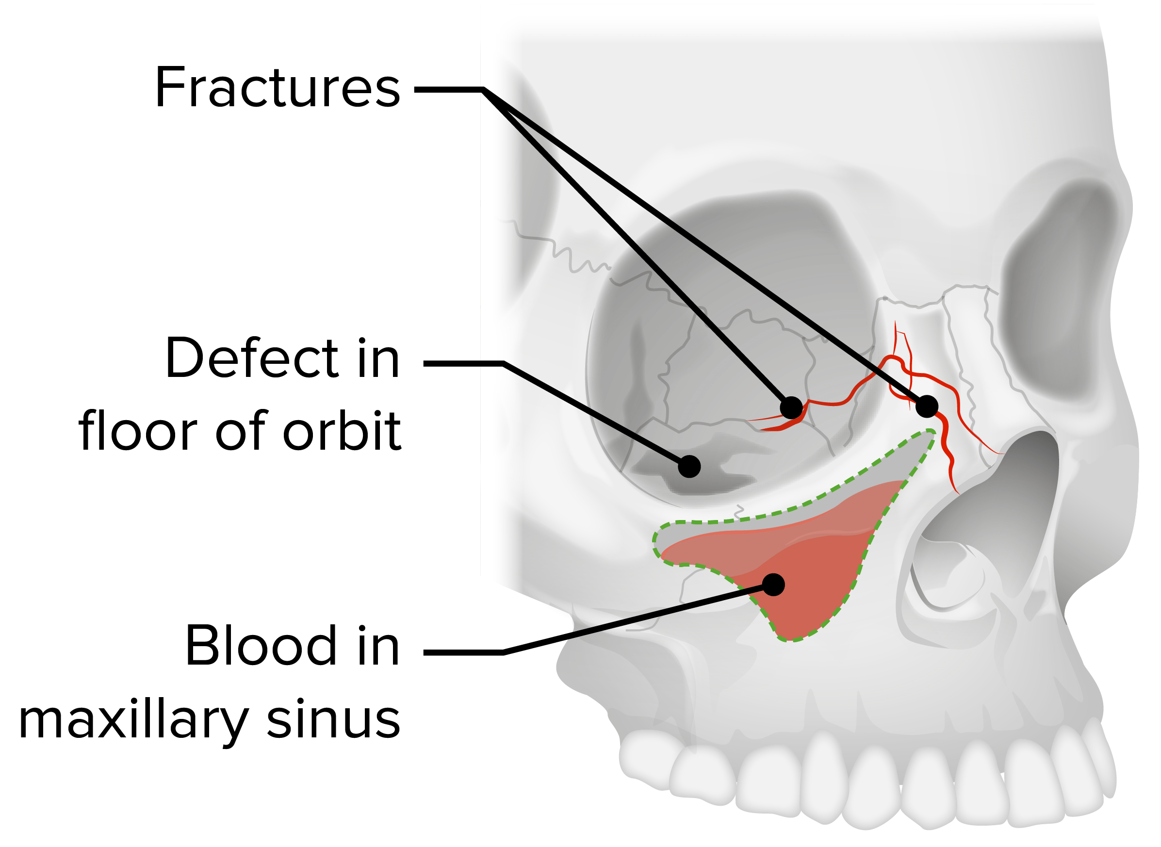 Orbital floor fracture