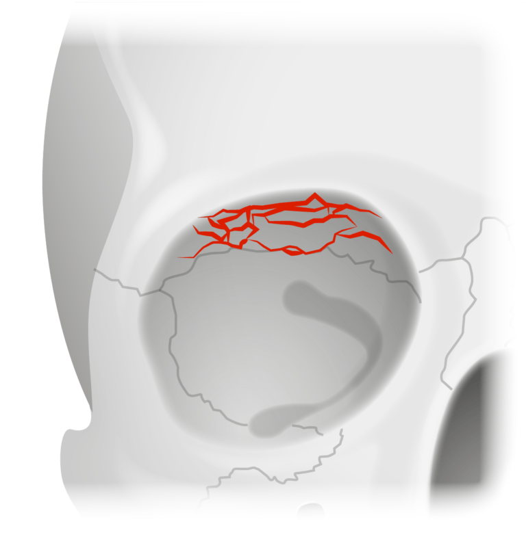 Fracturas Orbitales Concise Medical Knowledge