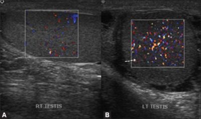 Orchitis Ct Scrotal Imaging | Concise Medical Knowledge