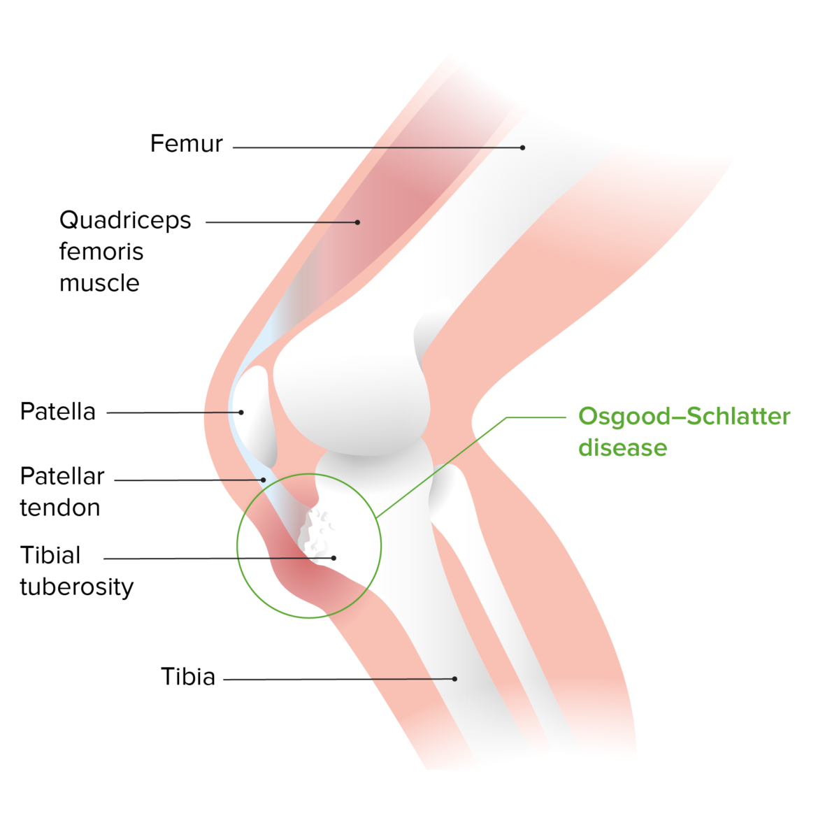 Osgood-shlatter disease