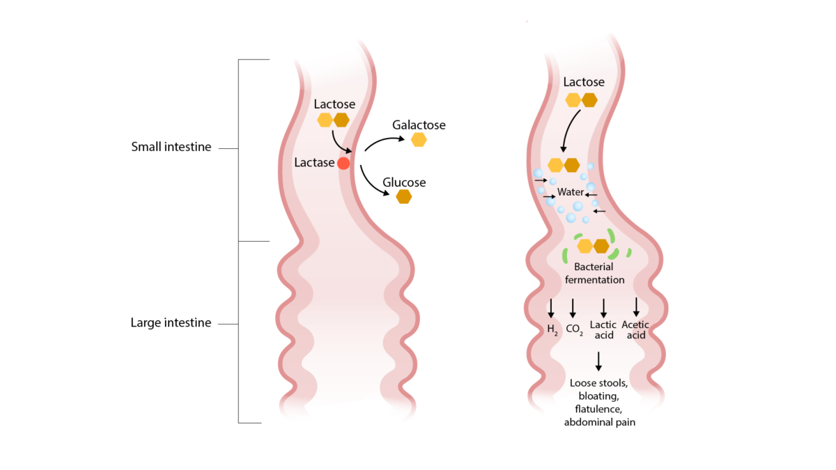 Osmotic diarrhea