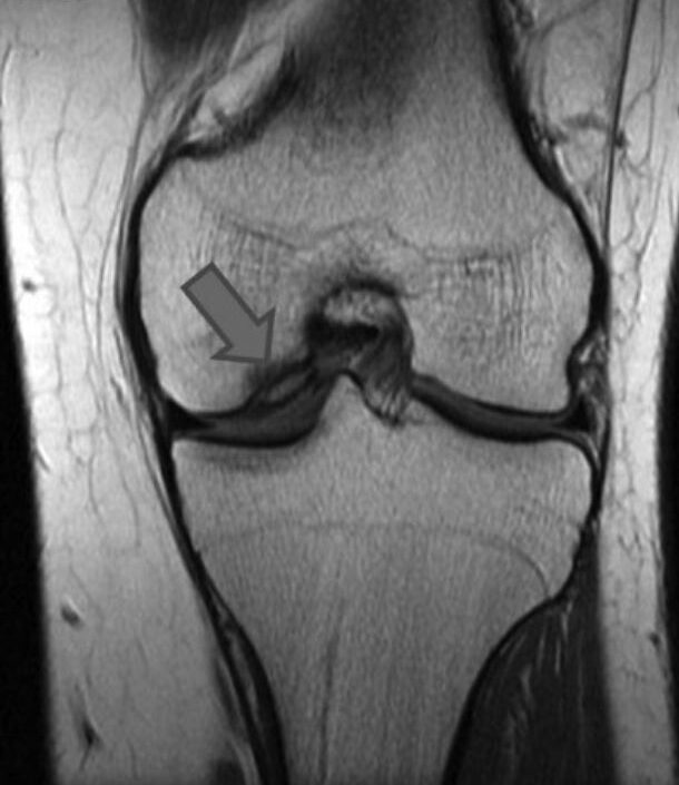 Ressonância magnética do joelho de um doente com osteocondrite dissecante