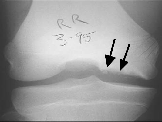 Osteochondritis dissecans knee x-ray