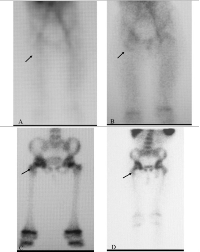 Osteomyelitis three-phase bone scan