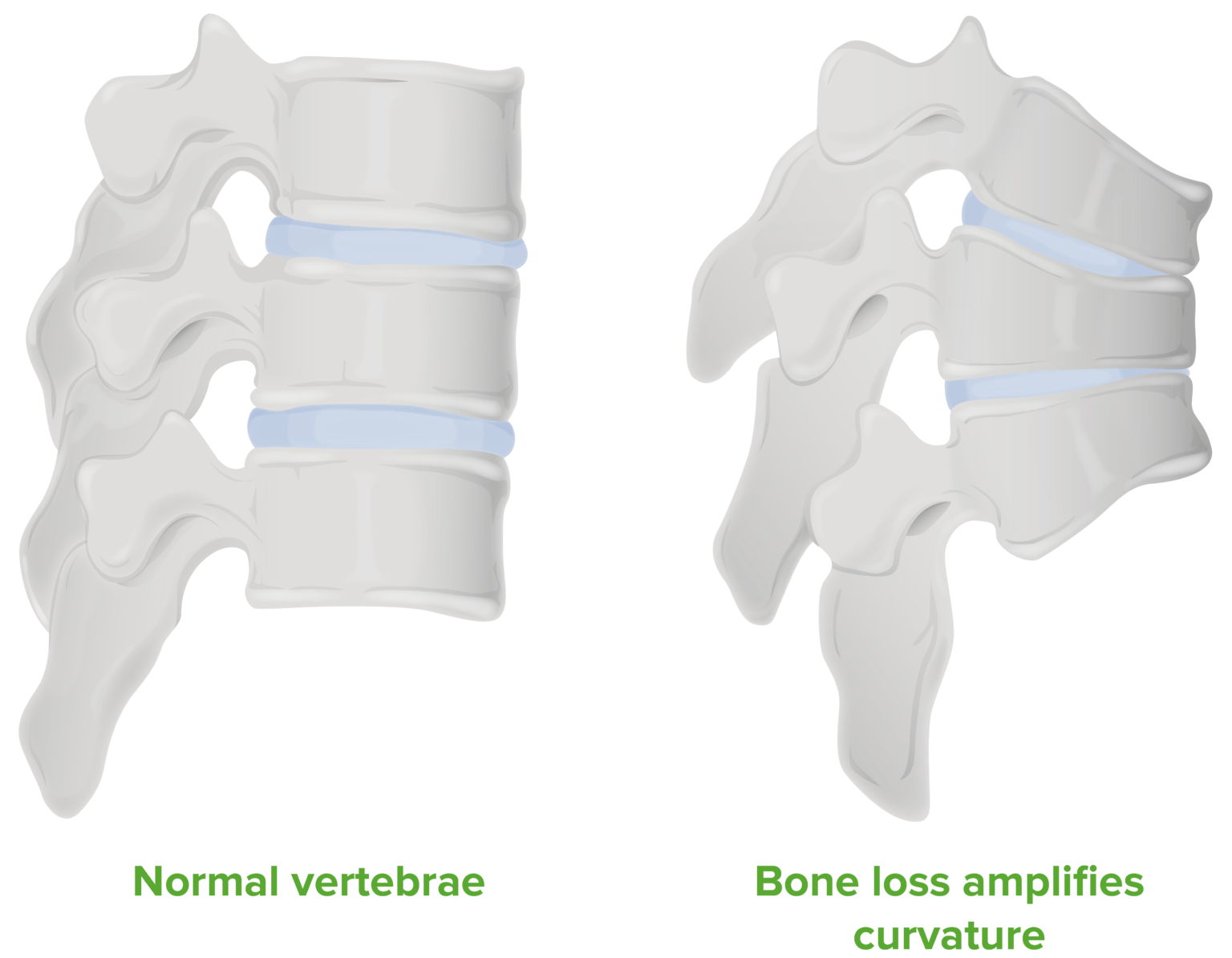Osteoporosis Concise Medical Knowledge