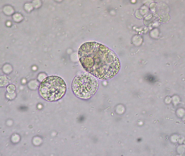 Corpos gordurosos ovais na microscopia de urina
