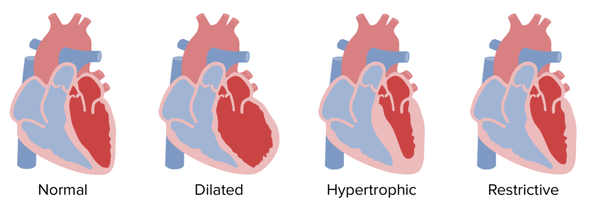 Overview of cardiomyopathies