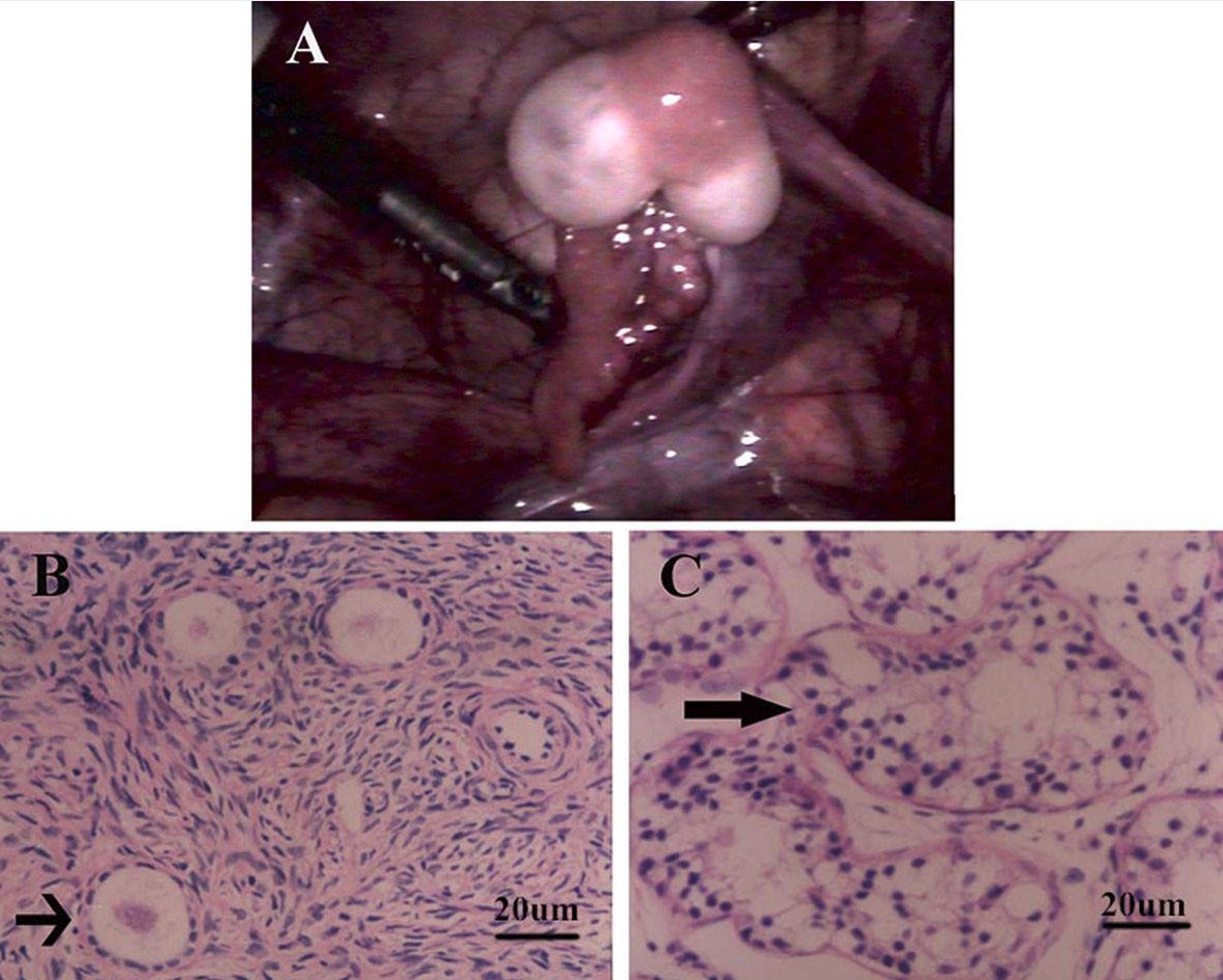 True Hermaphroditism | Concise Medical Knowledge