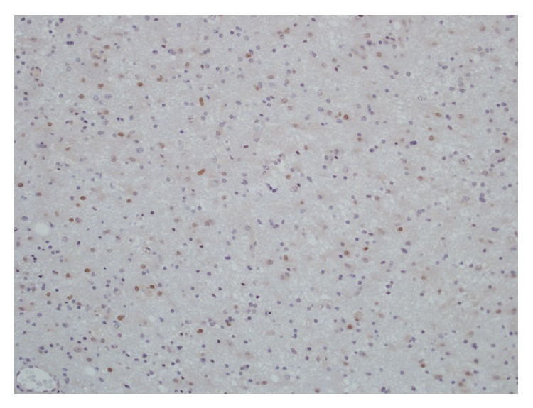 P53 immunopositivity of anaplastic astrocytoma