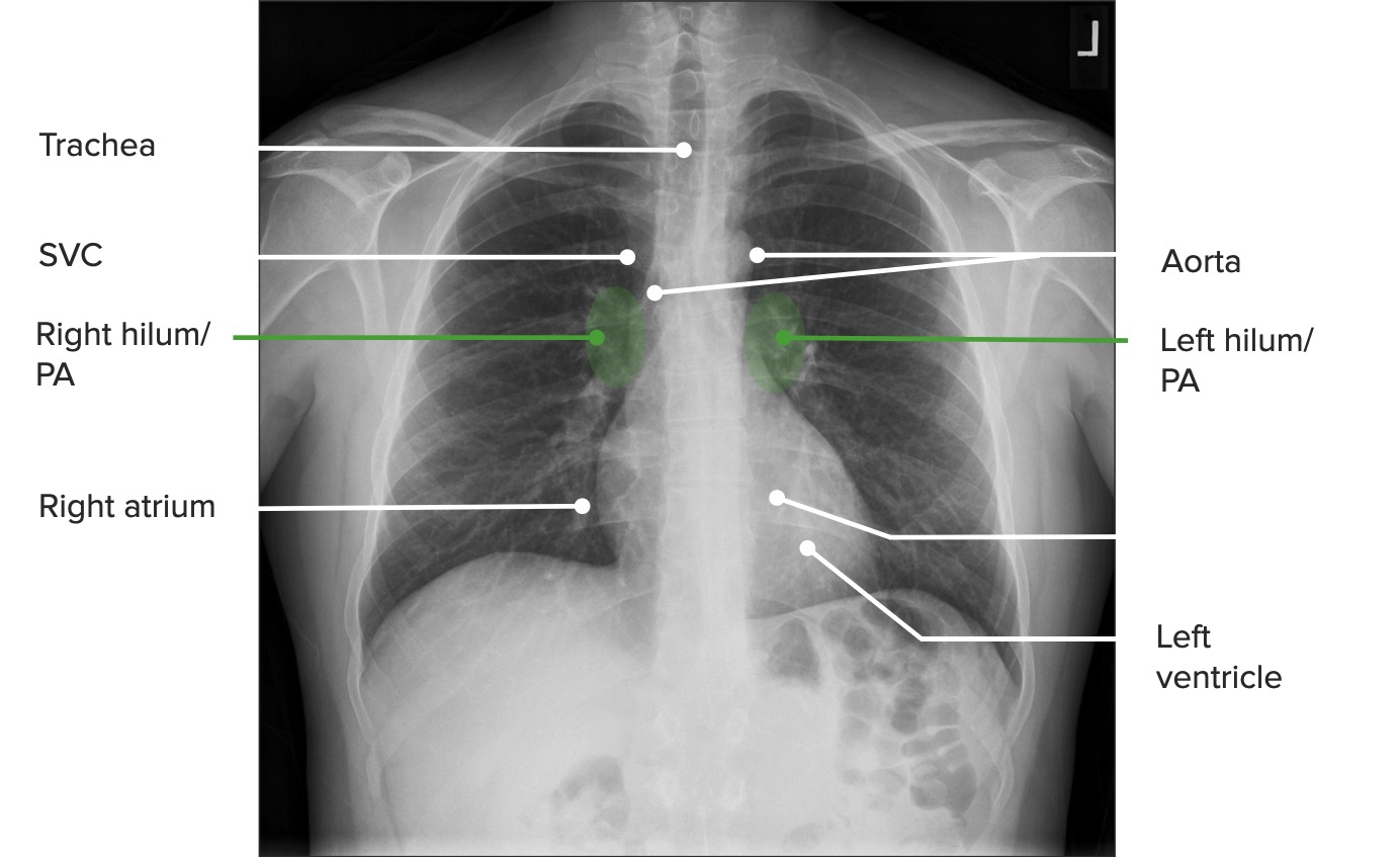 Pa projection of the chest identifying mediastinal structures