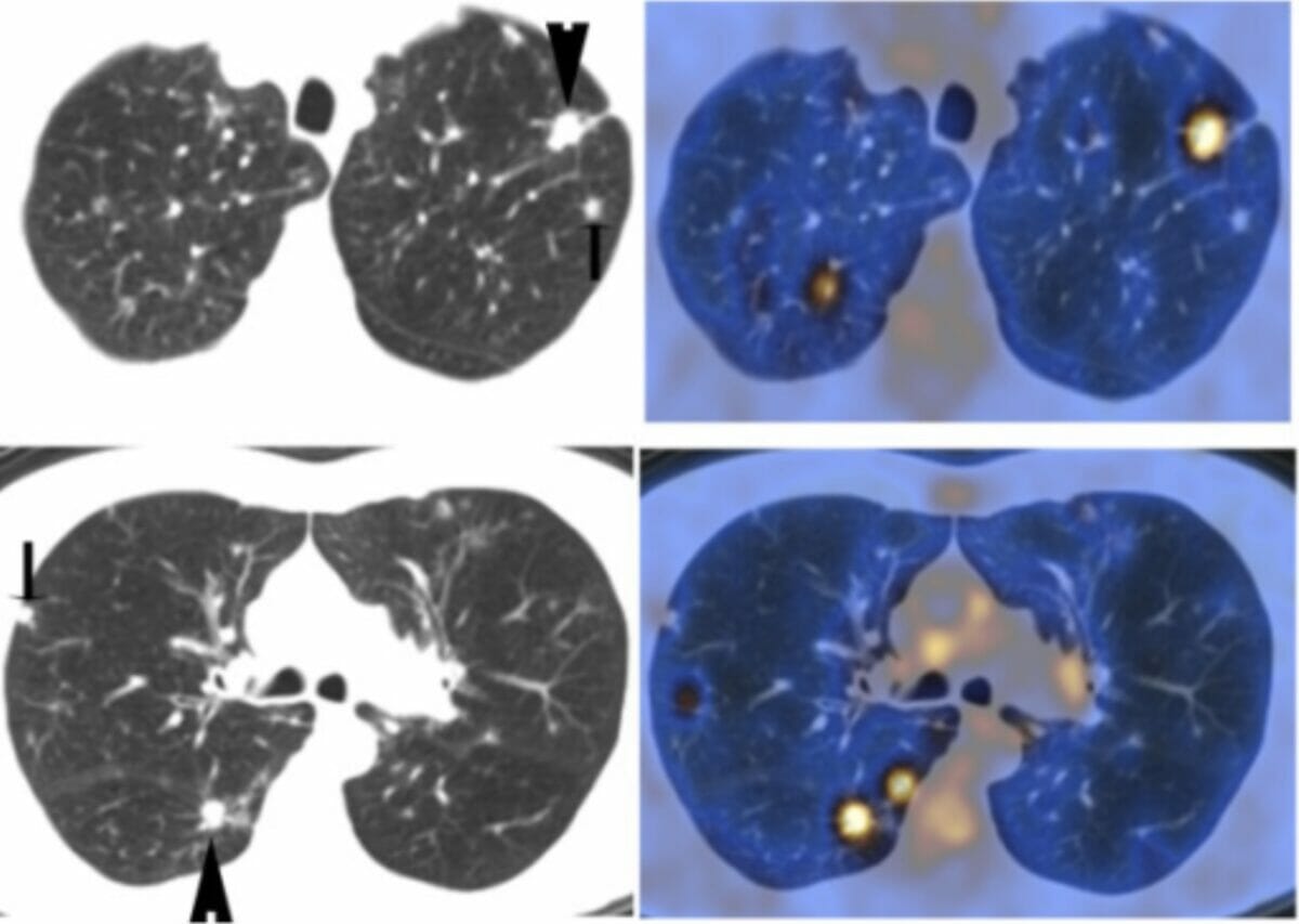Descobertas pet na histiocitose de células pulmonares nodulares de langerhans