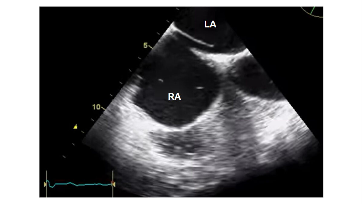 Ultrasonido del foramen oval persistente