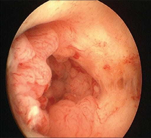 Carcinoma endometrium